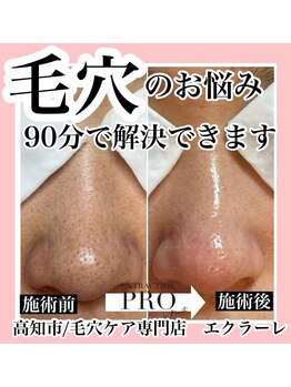 エクラーレ(Eclale)/【毛穴ケア】症例