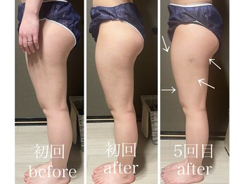 イーストモア(EAST MOIS)/前ももの筋肉の張りを解消