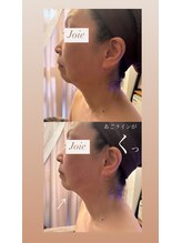 ジョワ(joie)/リフトアップフェイシャル