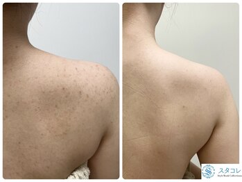 スタコレ スタイルブックコレクションズ 京橋店(Style Book Collections)/ハーブピーリング