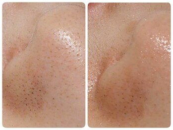 トータルビューティ ノイド(Noid)/毛穴洗浄　いちご鼻撃退