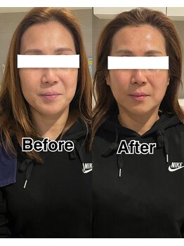シェリー(SHELLY)の写真/【小顔×肌質改善】肩甲骨や首・肩・顔の筋肉をほぐして骨格までアプローチ。ハーブピーリングと相性抜群。