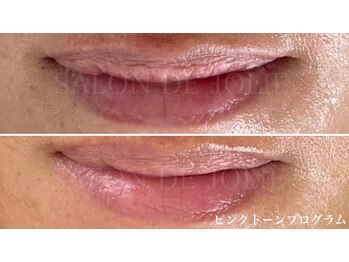 サロンドジョリー/唇のくすみケア