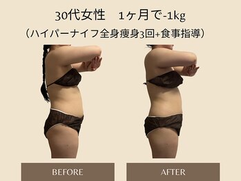 オベリオ(OBERIO)/ハイパーナイフ全身痩身