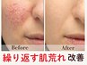 【頑張る大人女性応援】市内初導入☆乳酸ピーリング☆もっちり艶陶器肌