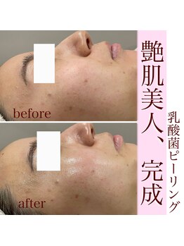 エミィシア(Emisia)/アンストレス