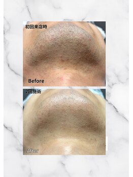 キムラケ(KIMURAKE)/ヒゲ脱毛に感動