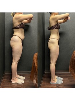 リノ(Lino)/食事制限なし！半年で11キロ減！