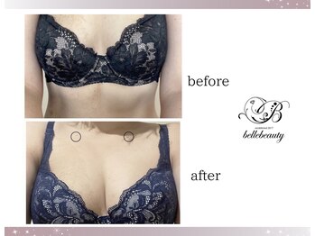 ベルビューティー(belle beauty)/バストアップ◇症例◇