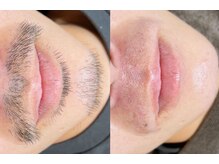 エイムユー(aim U)/最新脱毛器！ヒゲ脱毛！5500円