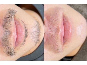 エイムユー(aim U)/最新脱毛器！ヒゲ脱毛！5500円