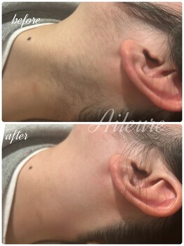 エルール トータルビューティ(Aileure total beauty)/うなじ美人　うなじ脱毛