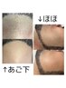 新常識！メンズ髭脱毛