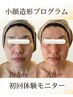 小顔ほうれい線たるみケア◎高周波リフトでぎゅっと引き締め◎初回体験8800円