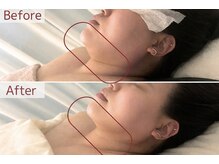 脱毛 痩身ぴゅあら/二重アゴすっきり！！