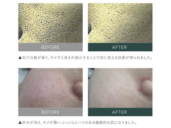 ルカ 北堀江(Luca)/毛穴レス水光肌へ