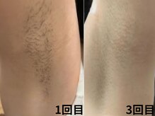 セルフメイド 山大通り店(SELFMADE)の雰囲気（セルフ脱毛でも変化感をしっかり実感いただけます！）