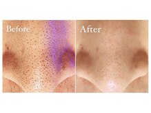 アトリウムオム 博多(ATRIUM HOMME)/ごっそり溜まった黒ずみも除去