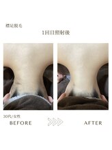 サロン エイトミー(salon 83)/【レディース脱毛】襟足