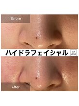 ビテキサロン ソワメーム(biteki salon SOI-MEME)/ハイドラフェイシャル