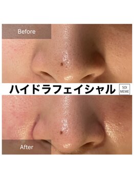 ビテキサロン ソワメーム(biteki salon SOI-MEME)/ハイドラフェイシャル