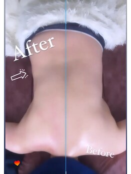 オーシャンブルーム 目黒(OceanBloom)/リンパマッサージハイパーナイフ