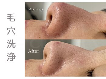 アニール(aniR)/ハーブピーリング/フェイシャル