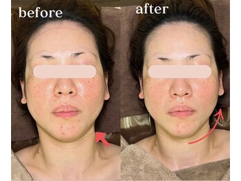 ソルニコン(Solnikon)/小顔術