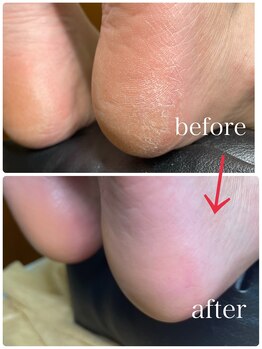 アンネイル(An nail)/足裏角質ケア