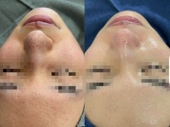 ピービー(PB)/エステダーマ