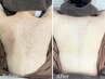 【背中ニキビケア・ザラザラ】 原因がわかる!!背中エステ当日施術相談¥13000