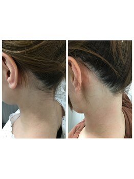 ミース 熊本店/うなじ矯正◆ビフォーアフター