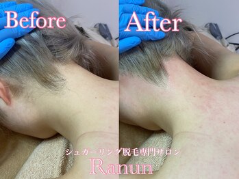 ラナン(Ranun)/全ての肌質に脱毛可能です