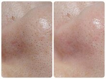 トータルビューティ ノイド(Noid)/毛穴洗浄　いちご鼻撃退