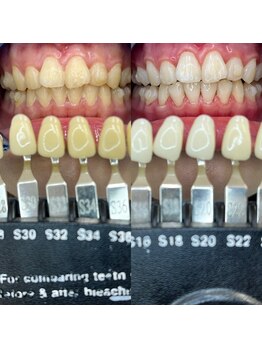 トウキョースワーズ 渋谷店(TOKYO SWRS)/#ホワイトニング #渋谷 #池袋