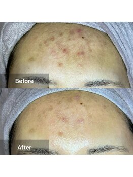 マリー(Mary.)/ハーブピーリング