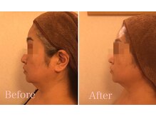 ネロリ(Neroli)/【小顔】脂肪分解レモンボトル