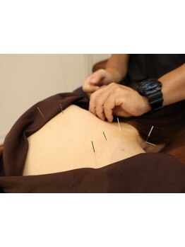 鍼灸施術を受けたい