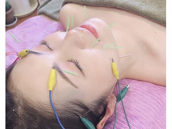 シシラ(shishira)/リフトアップには美容鍼を！