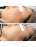 【再来★迷った方はこちら】フェイシャルニキビケアor背中ケア相談施術