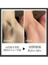 エリクサー 加須店(Elixir)/ワキ脱毛で毛とニオイとおさらば