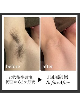 エリクサー 加須店(Elixir)/ワキ脱毛で毛とニオイとおさらば