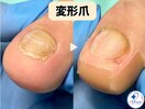 変形・肥厚した爪を正常な爪へ