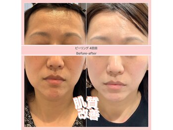 ディアメ(Diame)/美肌結果！