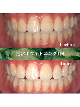 フタバ 天神大名店(futaba)/初回ホワイトニングbefore after