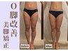 【O脚矯正】O脚が悩みで脚を隠すファッションばかり…そんな悩みを解決！