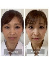 ハッピービューティーサロン じゆう(Happy Beauty Salon J∞YOU)/人気No.1/魔法の小顔矯正/2回目