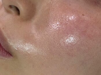 リジョーナ 一宮店(Lijona)/肌質改善サポートしてます