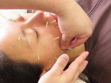 整骨院トリデ(整骨院TORIDE)の雰囲気（ダーマ鍼に合わせて美容鍼も施術すると、より効果が高くなります）