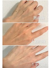 クラリス(Clarice)/手のシミ・ホクロ取れるんです！